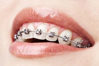 Garantía de Clínica - Dentistas de Confianza - Ortodoncia Brackets