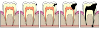 caries dentales 