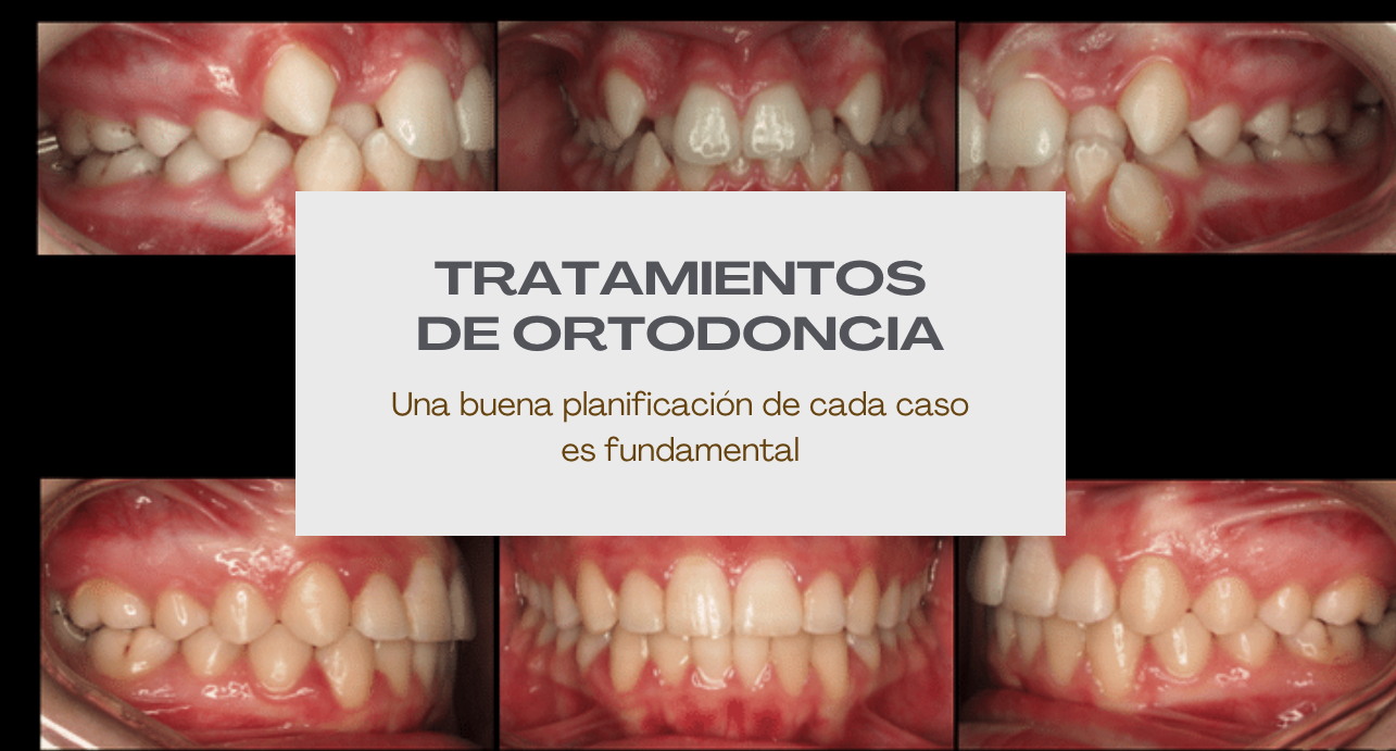 Caso de apiñamiento dental_dentista de confianza