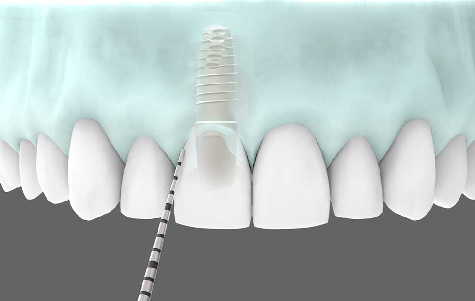 Club Dental Garantía de Clínica - Dentista de Confianza - Mantenimiento Implantes Dentales