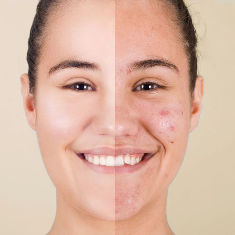 Antes y despues de ortodoncia