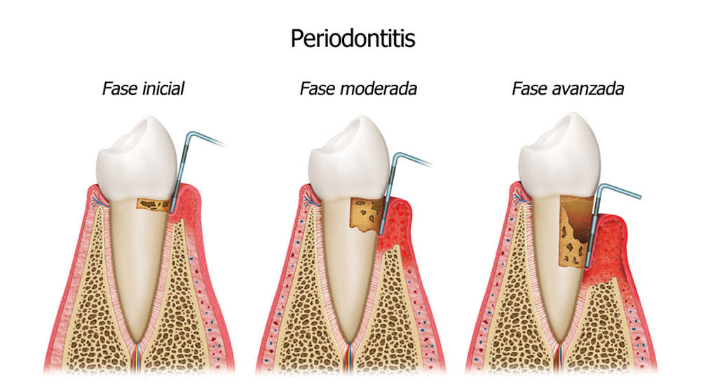 Garantía-de-Clínica-Dentista-de-Confianza-Periodontitis.jpg