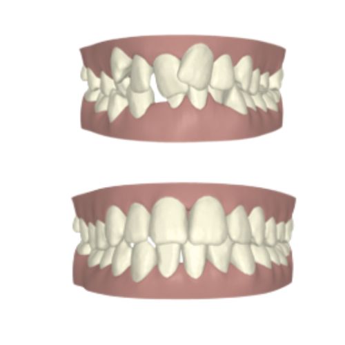 Caso de antes y despues en Ortodoncia con Invisalign