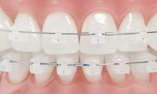 Garantía de Clínica - Dentistas de Confianza - Ortodoncia Brackets Zafiro