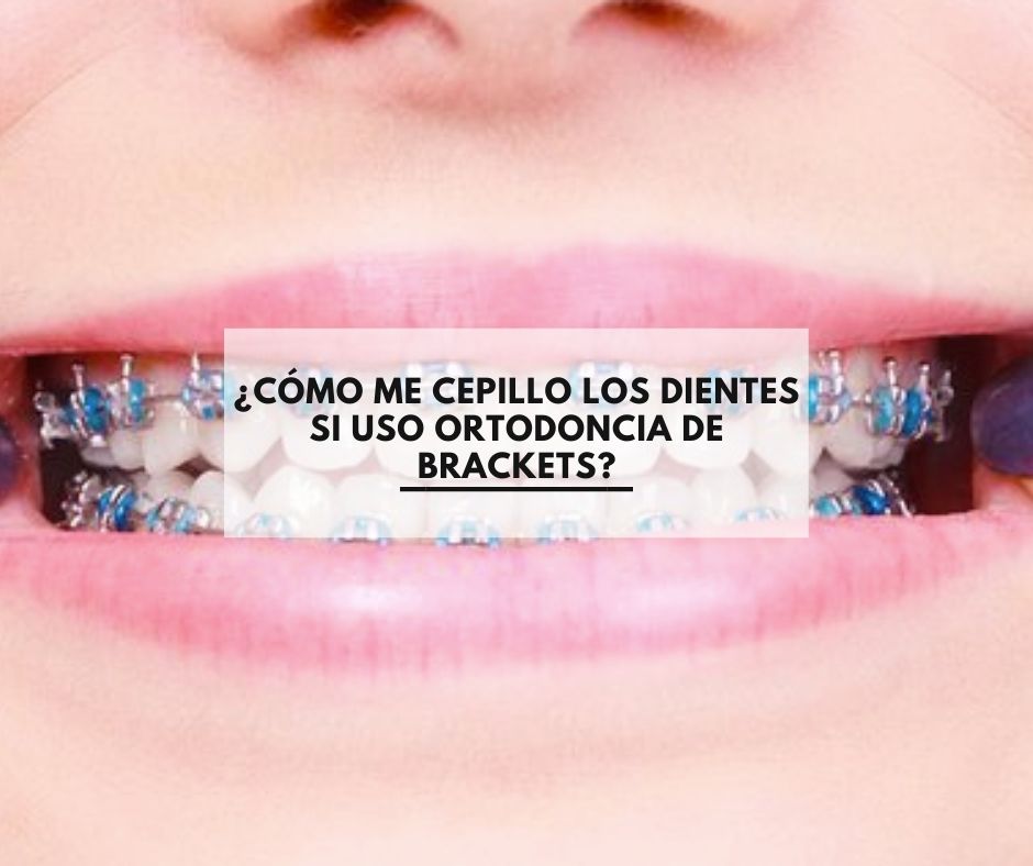 ¿Cómo me cepillo los dientes si uso ortodoncia de brackets?