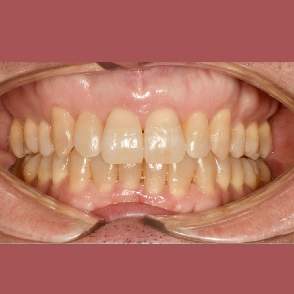 Clínica Dental Ikigai en el Cañaveral_Después
