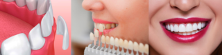 ¿Qué beneficios presentan las carillas dentales frente a otros tratamientos?